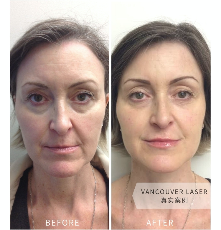 Vancouver Laser玻尿酸肉毒微调前后对比