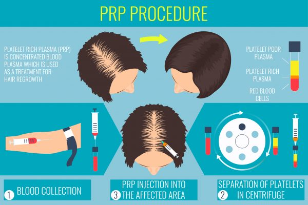 prp procedure
