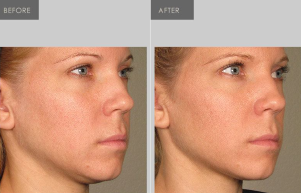 ultherapy jawline before and after Ultherapy tighten jawline