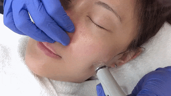 毛孔清洁Hydrafacial