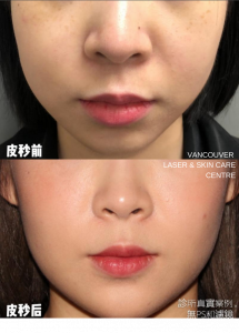 温哥华皮秒初体验