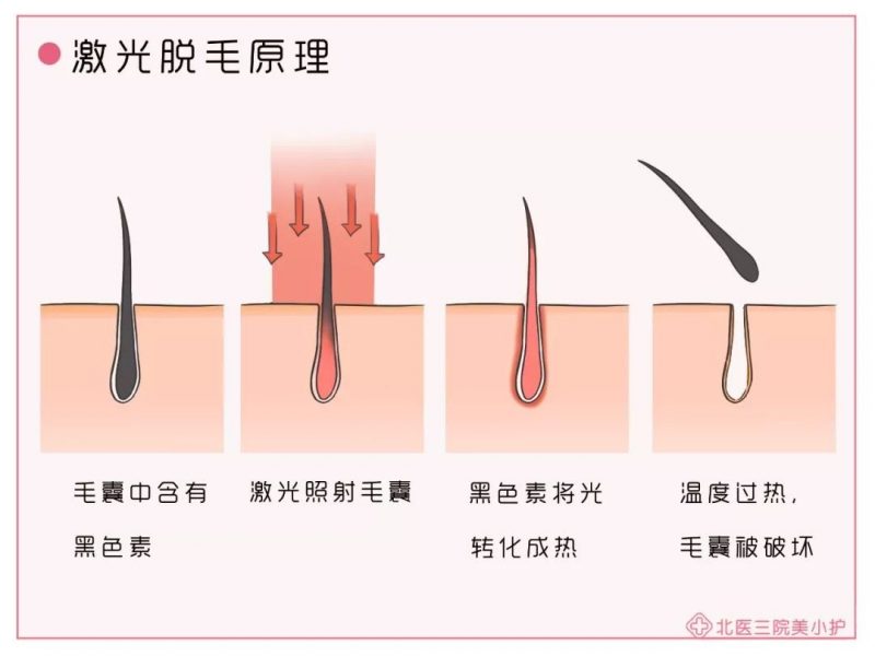 激光脱毛过程